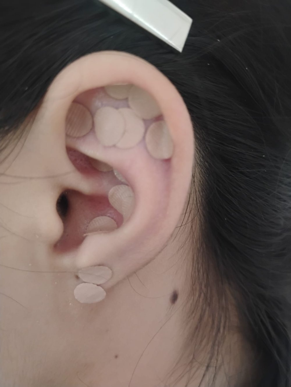 Sesión de auriculoterapia, oído con semillas de tratamiento