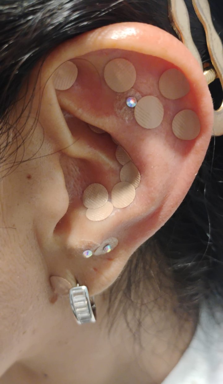 Sesión de auriculoterapia, oído con semillas de tratamiento